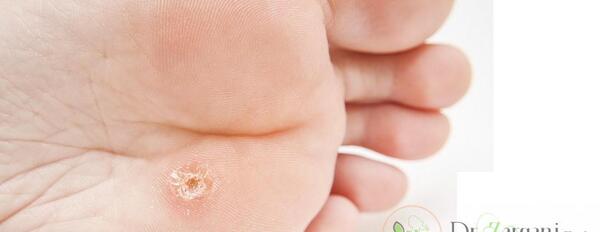 عکس ریشه میخچه پا نی نی سایت
