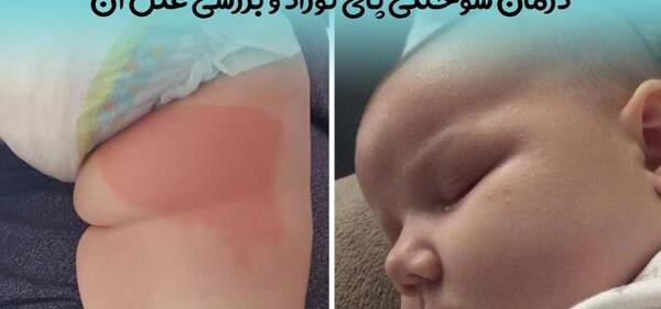 عکس سوختگی پای نوزاد با پوشک