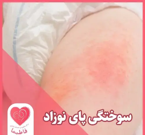 عکس سوختگی پای نوزاد با پوشک