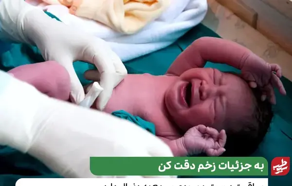 عکس بعد از افتادن حلقه ختنه نی نی سایت
