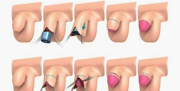 عکس بعد از افتادن حلقه ختنه نی نی سایت