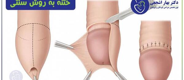 عکس بعد از افتادن حلقه ختنه نوزاد نی نی سایت