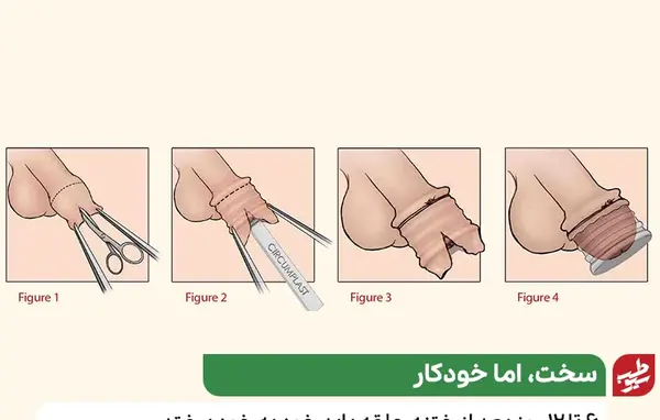 عکس بعد از افتادن حلقه ختنه نوزاد نی نی سایت