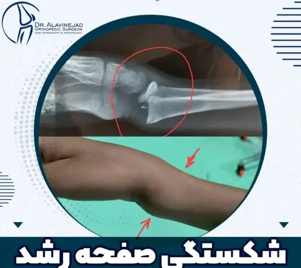 عکس از مچ دست برای رشد قد نی نی سایت