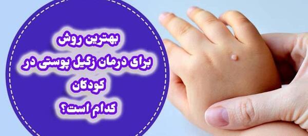 عکس میخچه دست نی نی سایت