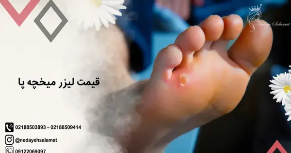 عکس میخچه دست نی نی سایت