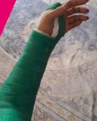 عکس دست شکسته نی نی سایت