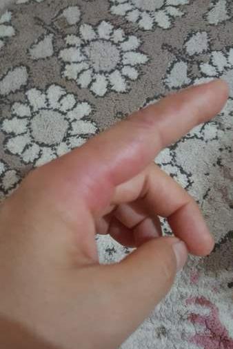 عکس دست شکسته نی نی سایت