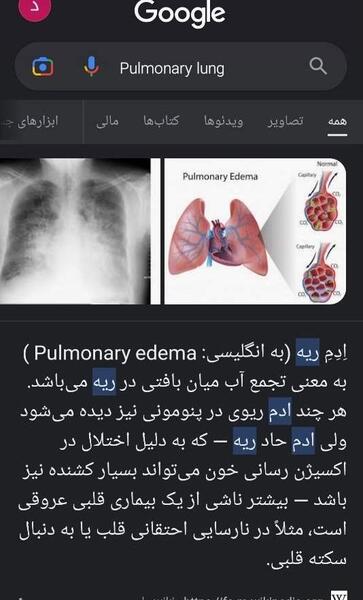 عکس ریه کودکان نی نی سایت