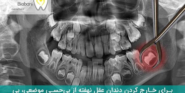 عکس رادیولوژی دندان نی نی سایت