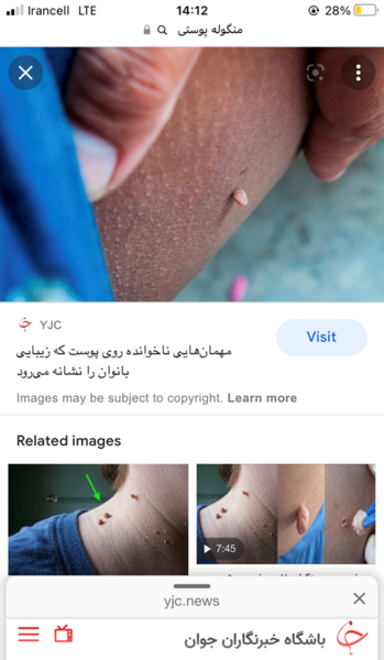 عکس تبخال تناسلی زنان نی نی سایت