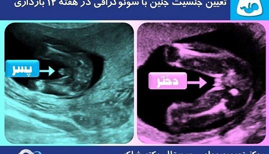عکس سونو انومالی دختر نی نی سایت