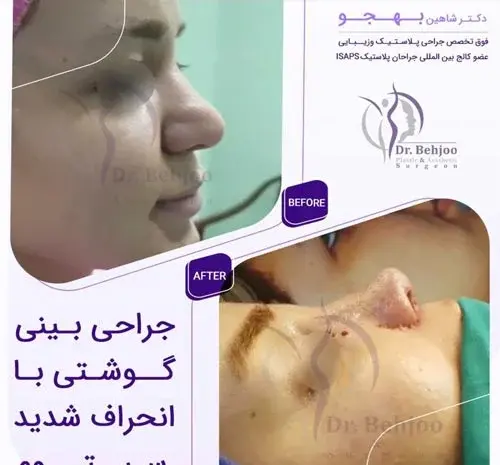 عکس عمل بینی گوشتی و پهن نی نی سایت