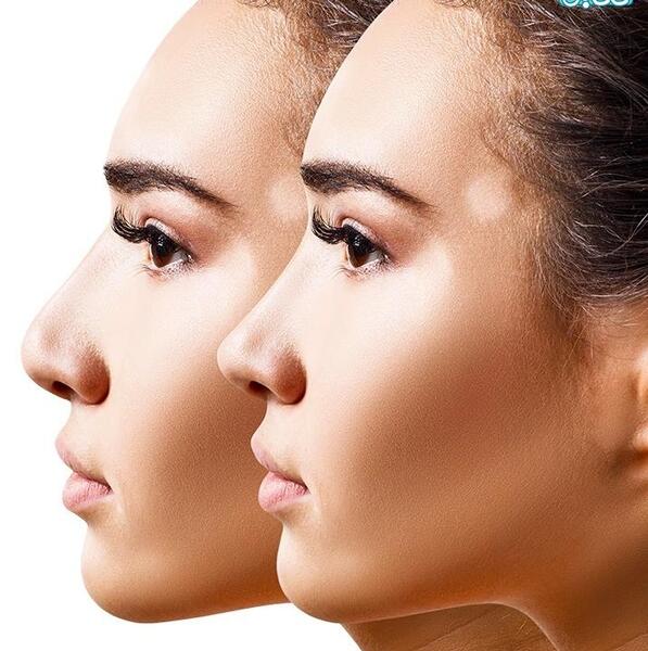 عکس عمل بینی گوشتی و پهن نی نی سایت