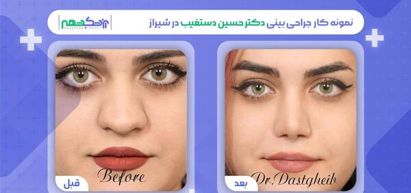 عکس عمل بینی گوشتی و پهن نی نی سایت