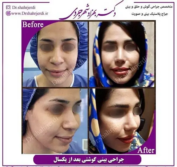 عکس عمل بینی گوشتی و پهن نی نی سایت