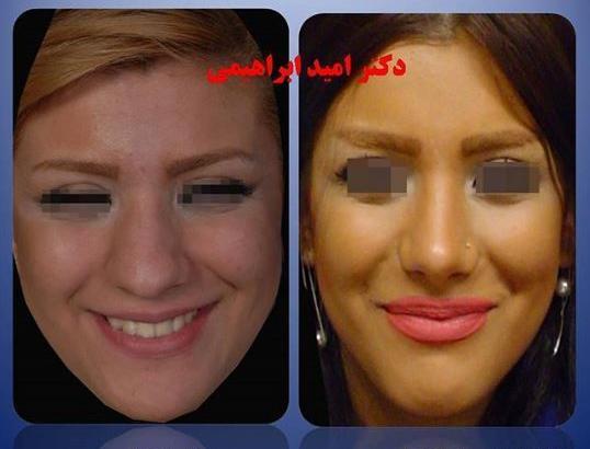 عکس عمل بینی گوشتی و پهن نی نی سایت