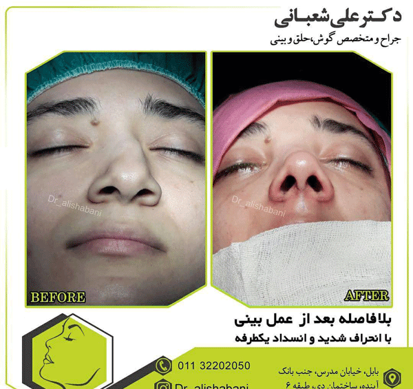 عکس عمل بینی گوشتی و پهن نی نی سایت