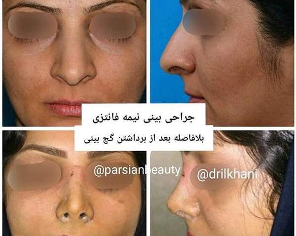 عکس عمل بینی گوشتی و پهن نی نی سایت