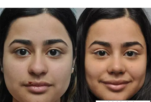 عکس عمل بینی گوشتی و پهن نی نی سایت