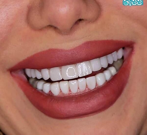 عکس گرفتن دندان نی نی سایت