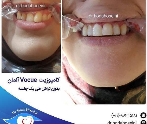 عکس گرفتن دندان نی نی سایت