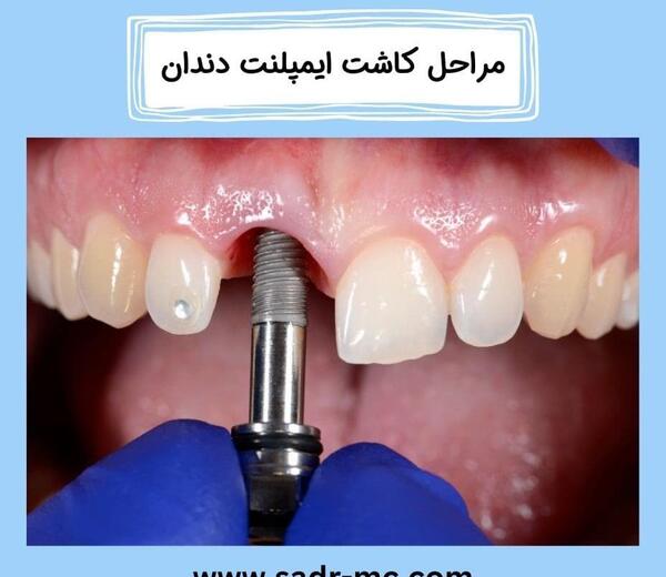 عکس گرفتن دندان نی نی سایت