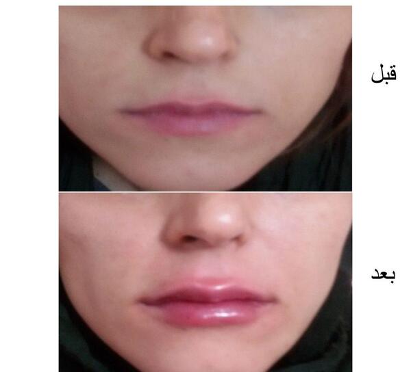عکس قبل و بعد شیدینگ لب نی نی سایت