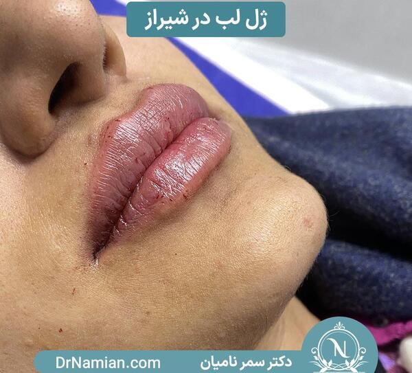عکس پروتز لب نی نی سایت