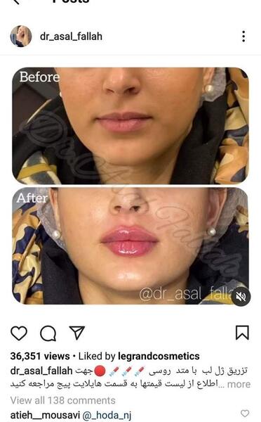 عکس پروتز لب نی نی سایت