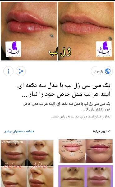 عکس پروتز لب نی نی سایت