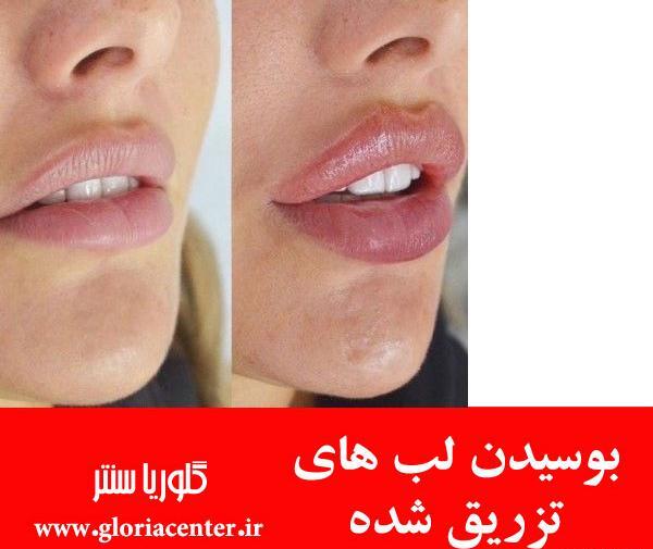 عکس پروتز لب نی نی سایت