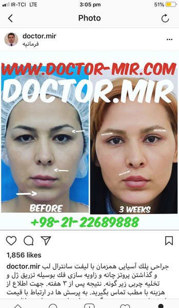 عکس پروتز لب نی نی سایت