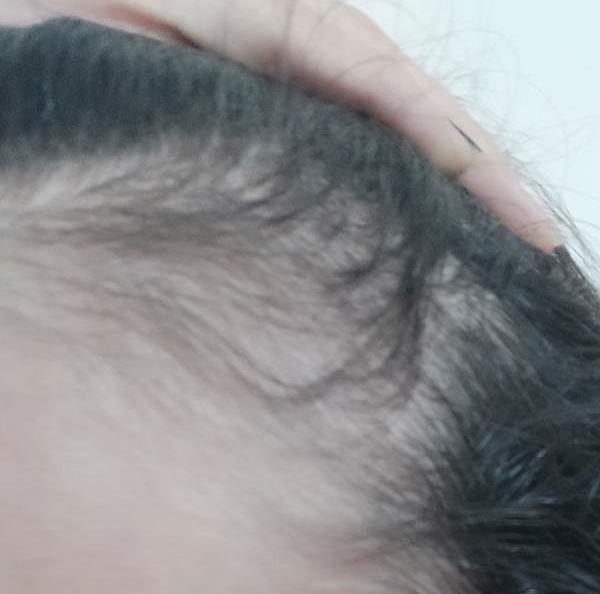 عکس قبل و بعد مزوتراپی مو نی نی سایت