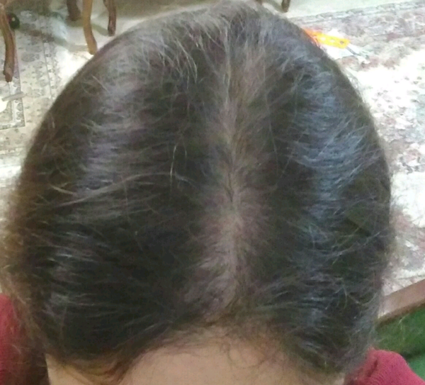 عکس قبل و بعد مزوتراپی مو نی نی سایت