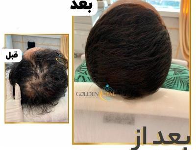 عکس قبل و بعد مزوتراپی مو نی نی سایت