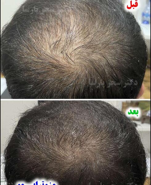 عکس قبل و بعد مزوتراپی مو نی نی سایت