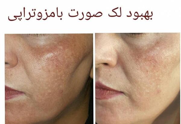 عکس قبل و بعد مزوتراپی مو نی نی سایت