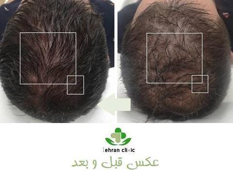 عکس قبل و بعد مزوتراپی مو نی نی سایت