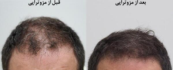 عکس قبل و بعد مزوتراپی مو نی نی سایت