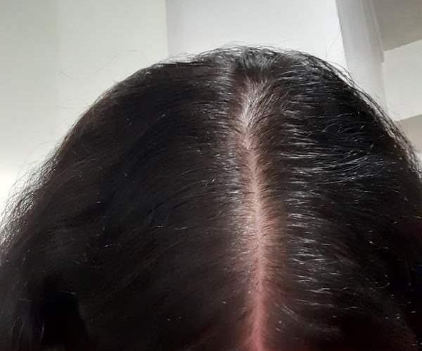 عکس ریزش مو نی نی سایت