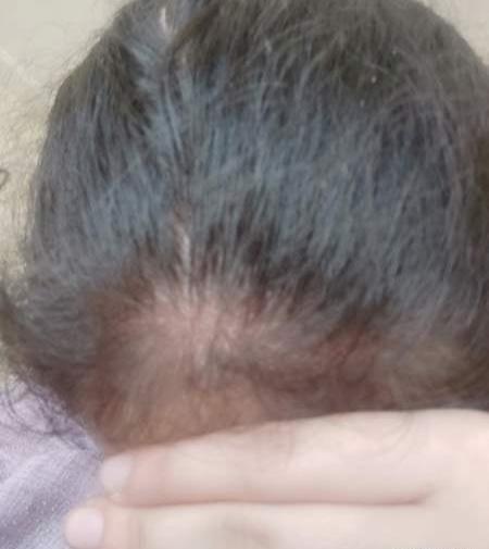 عکس ریزش مو نی نی سایت