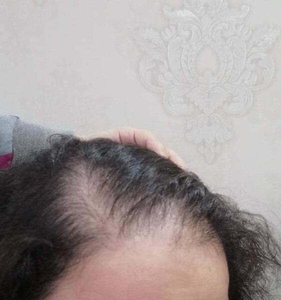 عکس ریزش مو نی نی سایت