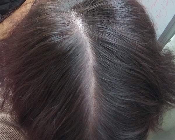 عکس ریزش مو نی نی سایت