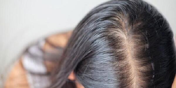 عکس ریزش مو نی نی سایت