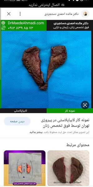 عکس های عمل لابیاپلاستی نی نی سایت