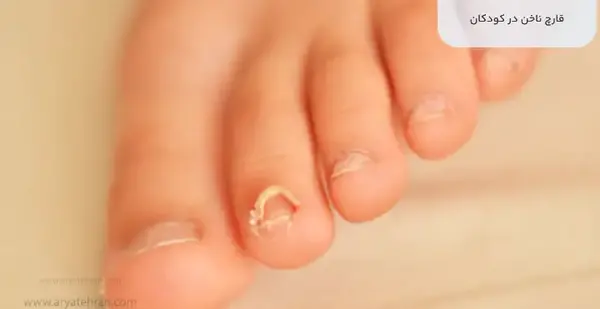 عکس قارچ ناخن نی نی سایت