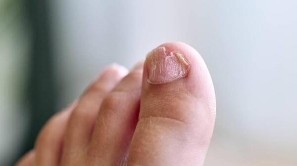 عکس قارچ ناخن نی نی سایت