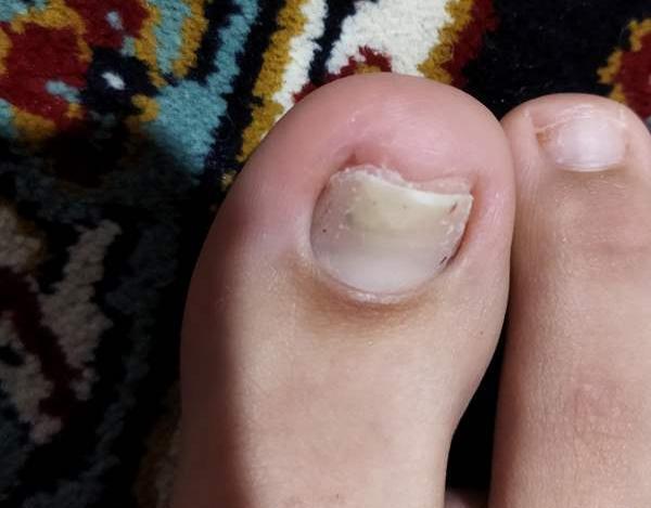 عکس قارچ ناخن نی نی سایت