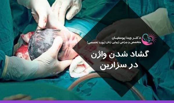 عکس واژن بعد از زایمان طبیعی نی نی سایت